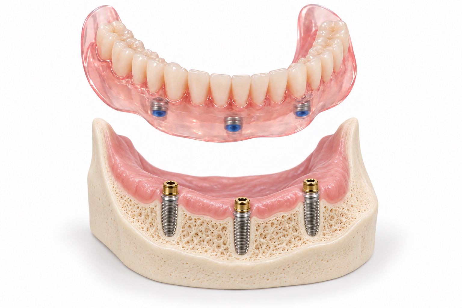 Lower snap-on denture with three attachment housings shown above three implants in a jaw model